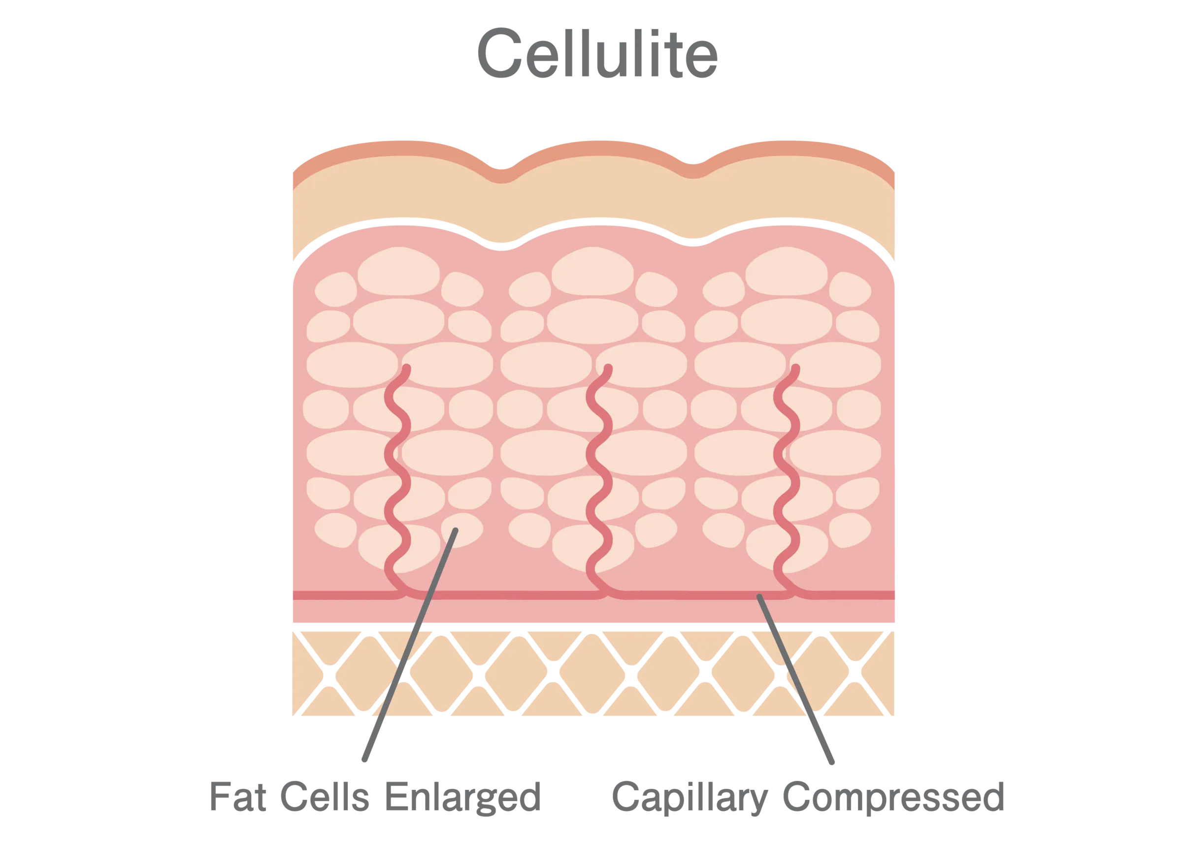 Skin layers with cellulite